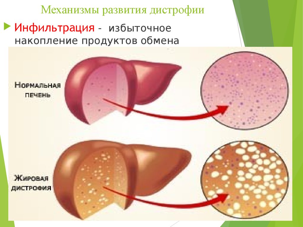 Что такое жировая дегенерация печени. Механизмы развития дистрофии. Механизм жировой дистрофии. Инфильтрация это в патологии. Дистрофия печени этиология.