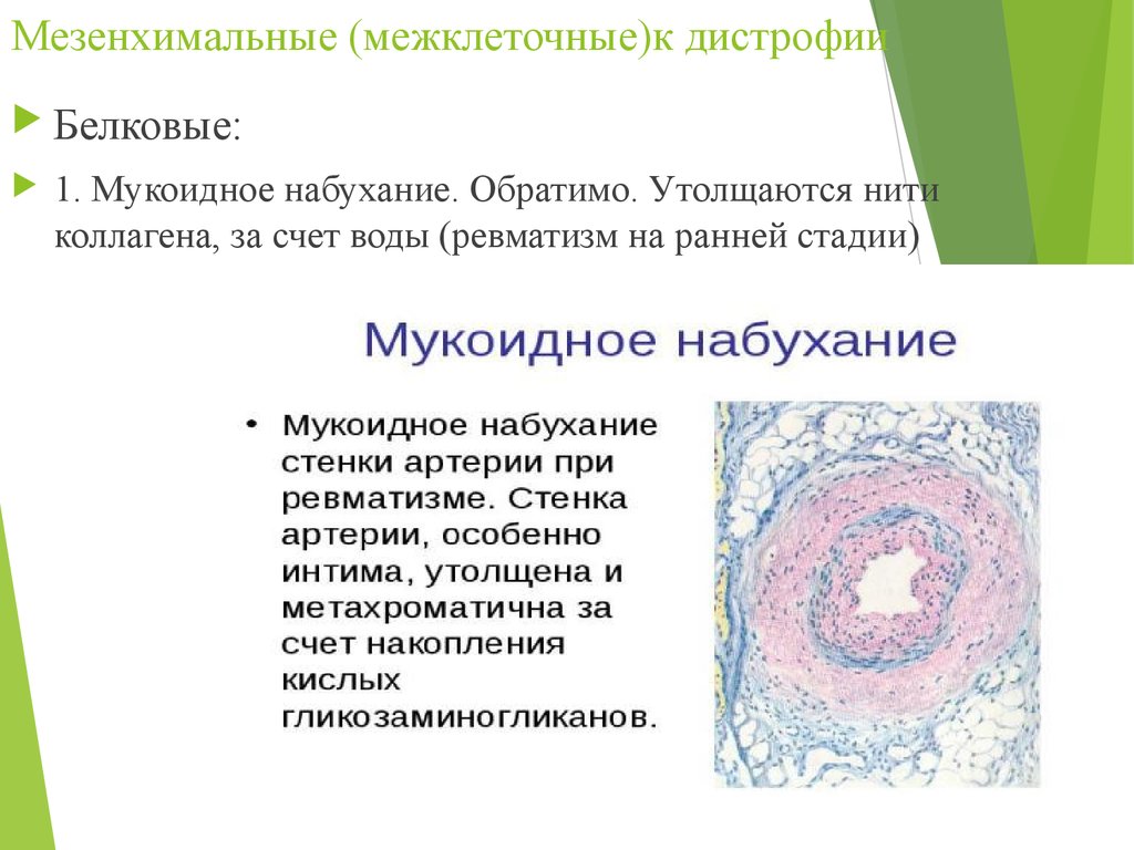 Гиалиноз относится к. Белковые мезенхимальные дистрофии мукоидное набухание. Мезенхимальные дистрофии таблица мукоидное набухание. Фибриноидное набухание микроскопия. Мезенхиальные белковая дистрофия.