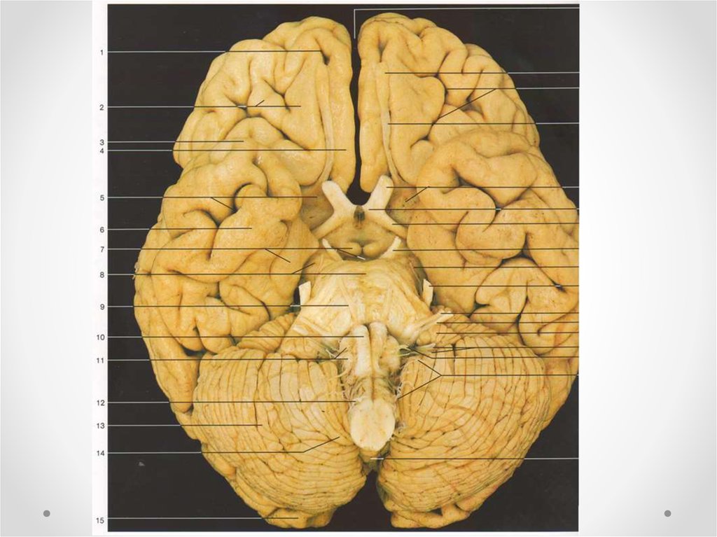 Нижняя поверхность мозга. Нижняя поверхность полушарий головного. Свод мозга.