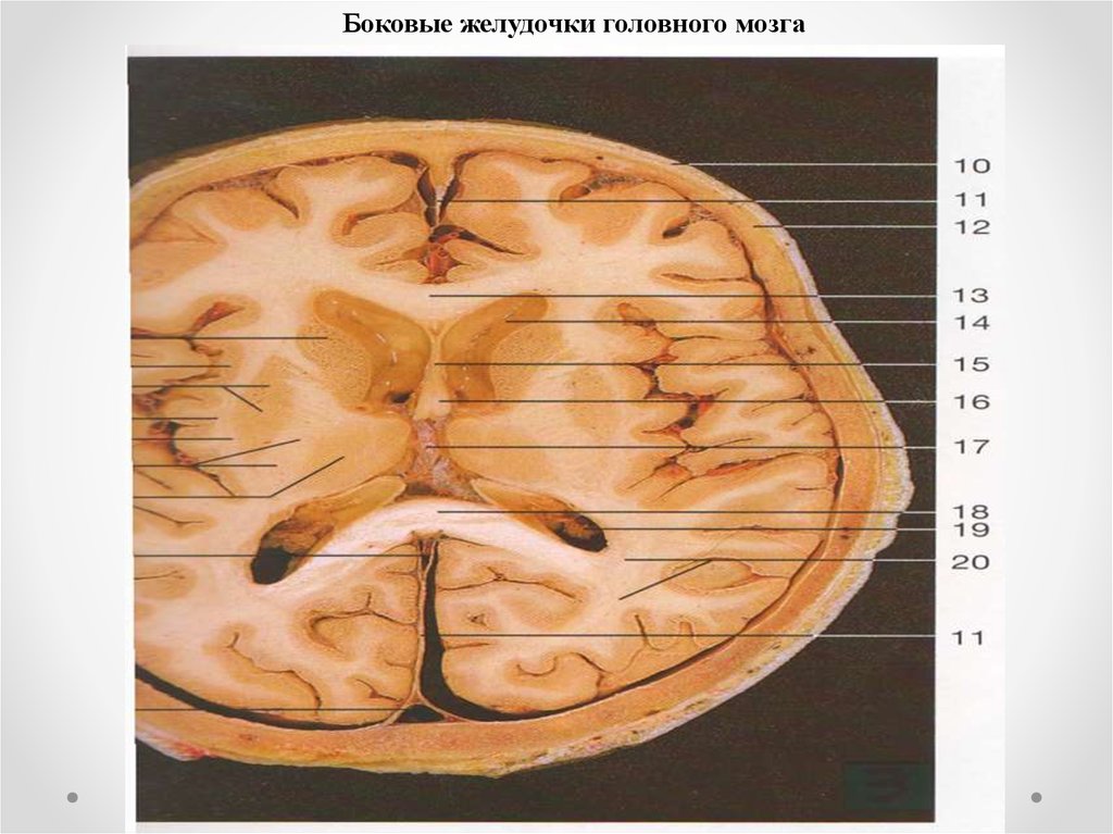 Размеры боковых желудочков мозга