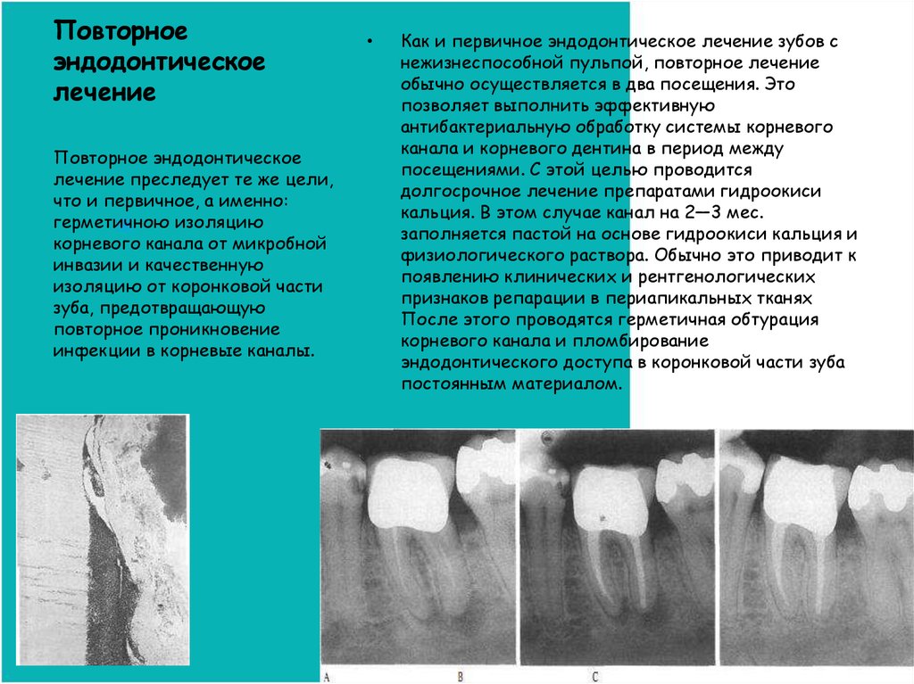 Осложнения эндодонтического лечения. Эндодонтическое перелечивание зубов. Протокол обработки корневых каналов в молочных зубах. Эндодонтия корневых каналов этапы. Критерии оценки корневых каналов эндодонтия.