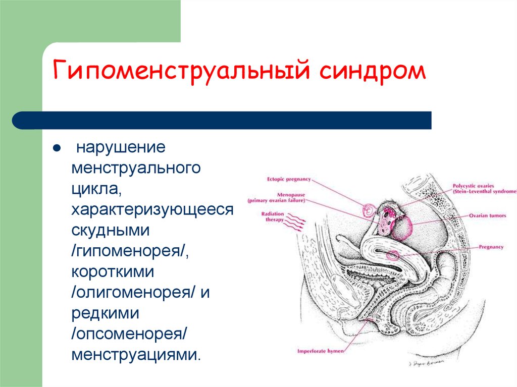 Гипоменструальный синдром презентация