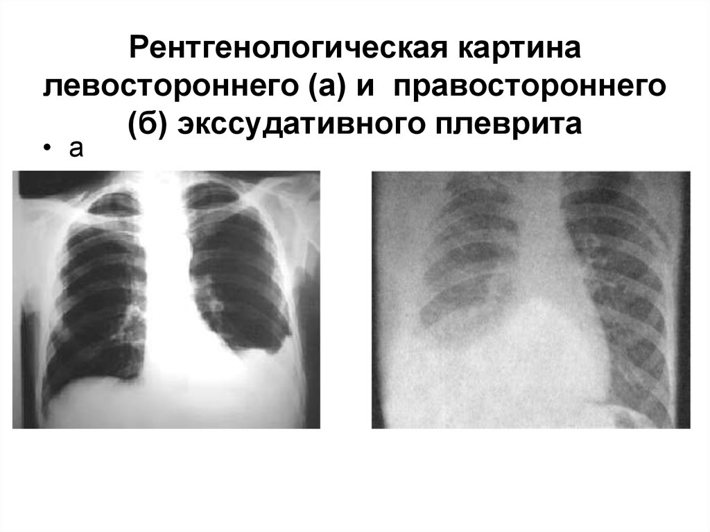 Экссудативный плеврит рентгенологическая картина