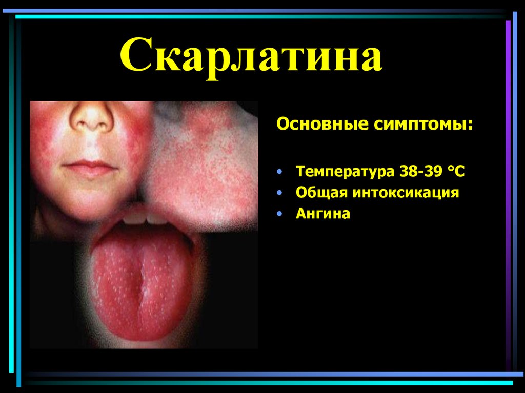 Скарлатина у детей симптомы фото горла