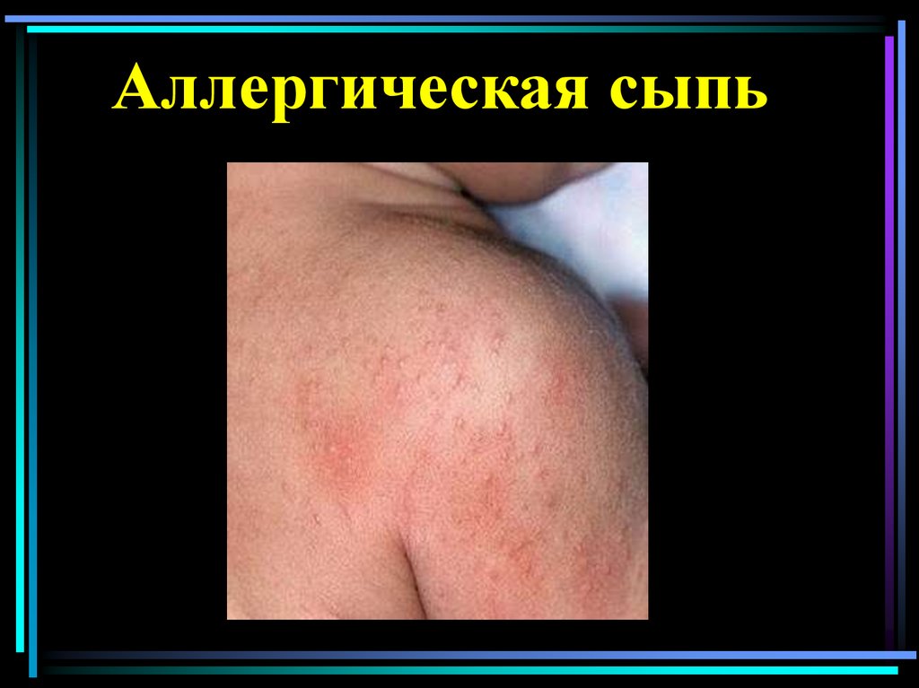 Аллергическая сыпь