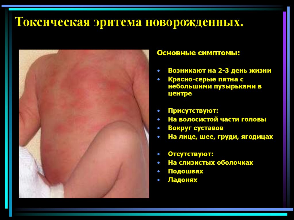Токсическая эритема новорожденных.