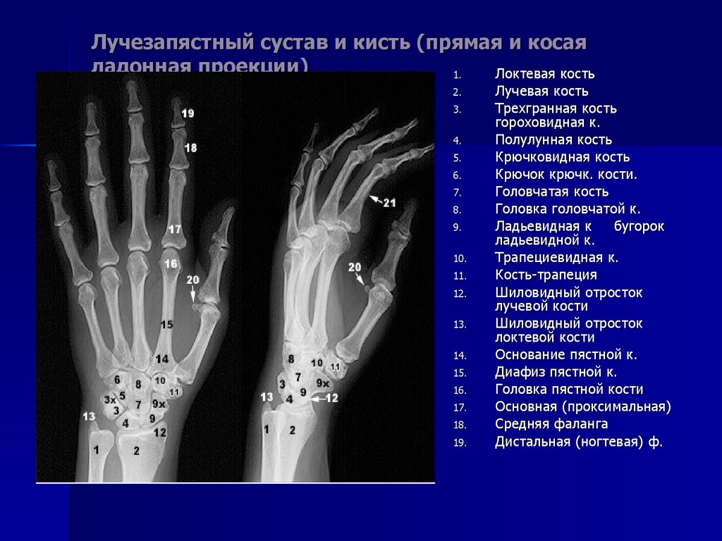 Суставы правой руки. Лучезапястный сустав рентген анатомия. Кости запястья рентгеноанатомия. Кости кисти руки человека анатомия рентген. Нормальная рентген анатомия лучевой кости.