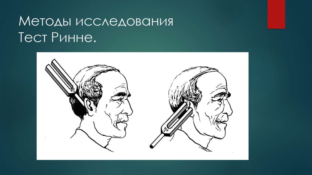 Проба вебера. Проба Вебера Ринне Швабаха. Камертональные исследования слуха. Камертонные пробы опыт Вебера. Опыт Вебера Ринне Швабаха.