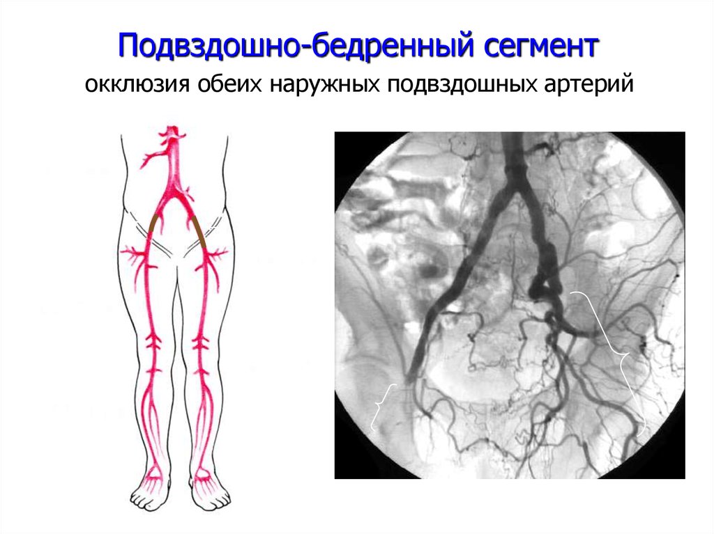 Правая подвздошная артерия. Тромбоз бедренной вены. Подвздошная артерия схема. Ангиограмма подвздошных артерий. Ангиография артерий нижних конечностей.