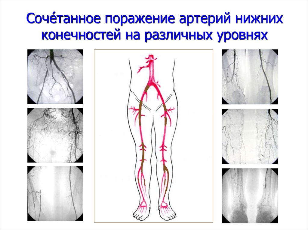 Магистральные артерии нижних конечностей. Рентгеноанатомия артерий нижних конечностей. Артерий нижних конечностей схема для УЗИ. Рентгенанатомия артерий нижней конечности. Пульсация артерий нижних конечностей схема.