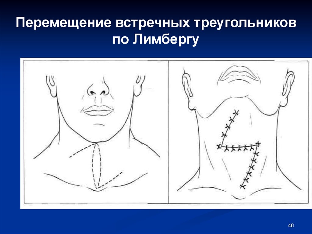 Пластика кожи. Пластика по Лимбергу встречными лоскутами. Пластика встречными треугольными лоскутами по Лимбергу. Метод по Лимбергу. Лимберг пластика местными тканями.