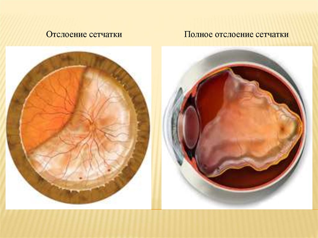 Отслойка сетчатки причины. Регматогенная отслойка сетчатки глаза. Воронкообразная отслойка сетчатки. Отслойка сетчатки зрение. Пациент с отслойкой сетчатки.