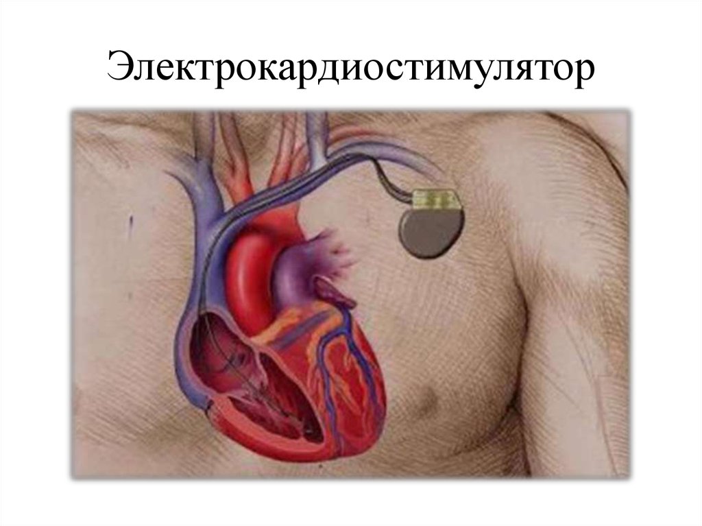 Кардиостимулятор сердца. Схема установки двухкамерного кардиостимулятора. Имплантация электрокардиостимулятора.