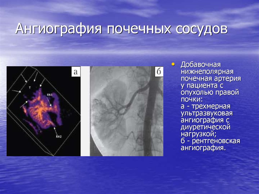 Почечная ангиография презентация