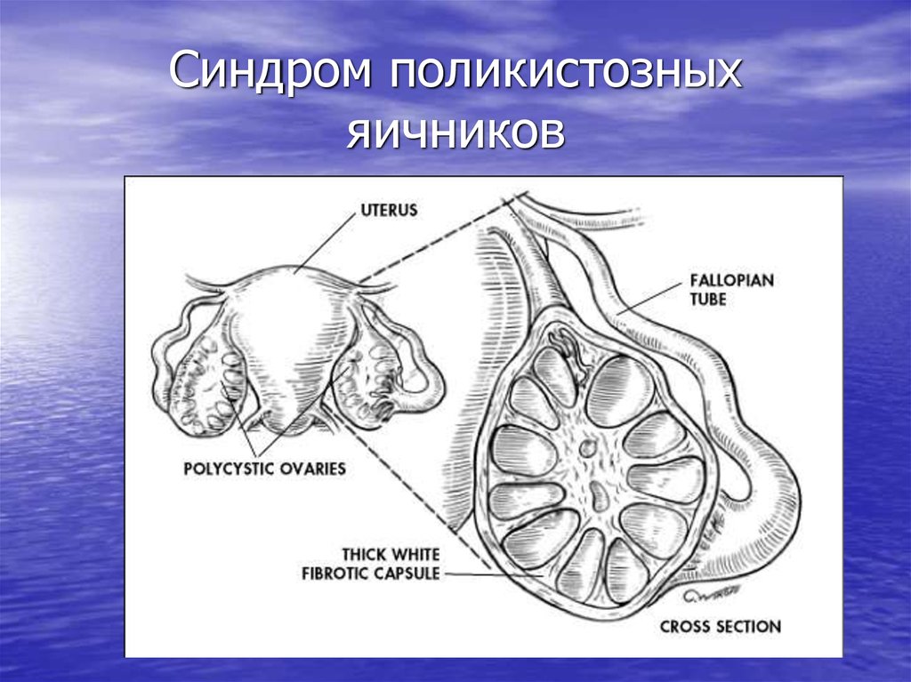 Синдром поликистозных яичников