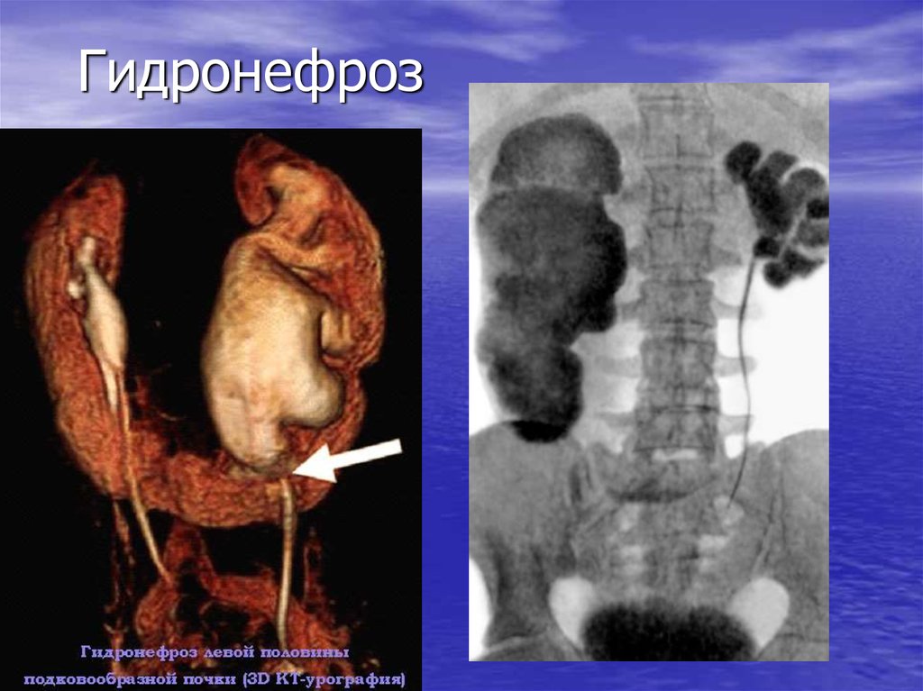 Гидронефроз