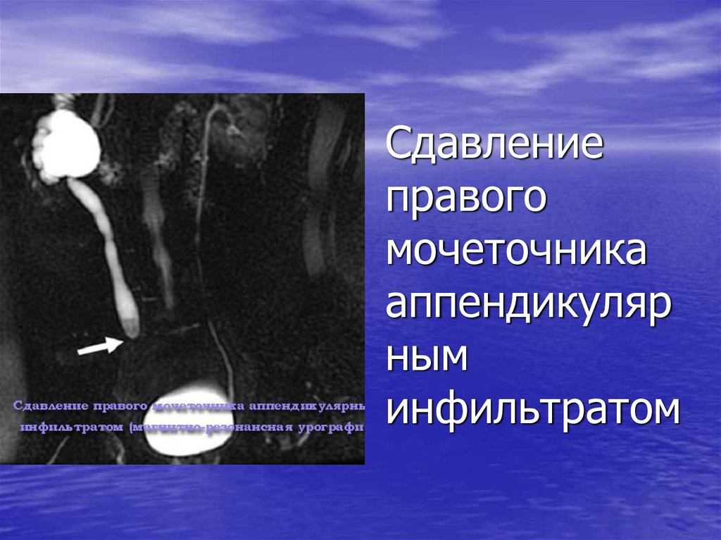 Сдавление правого мочеточника аппендикулярным инфильтратом