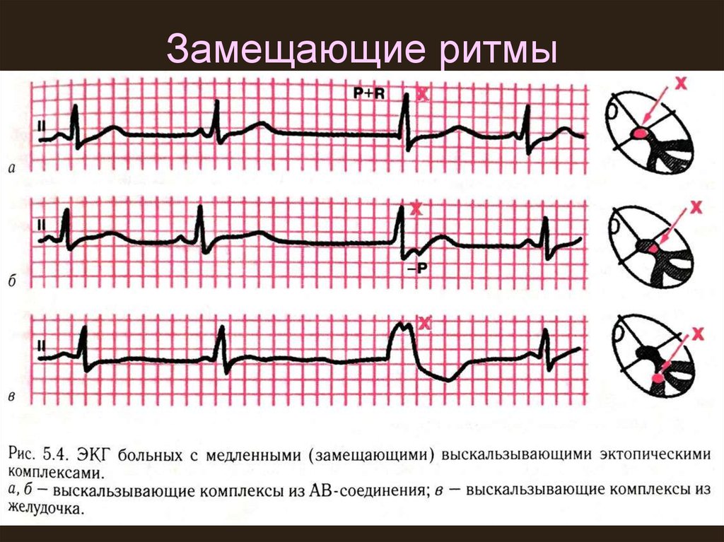 Узловой ритм сердца возникает когда роль водителя ритма берет на себя