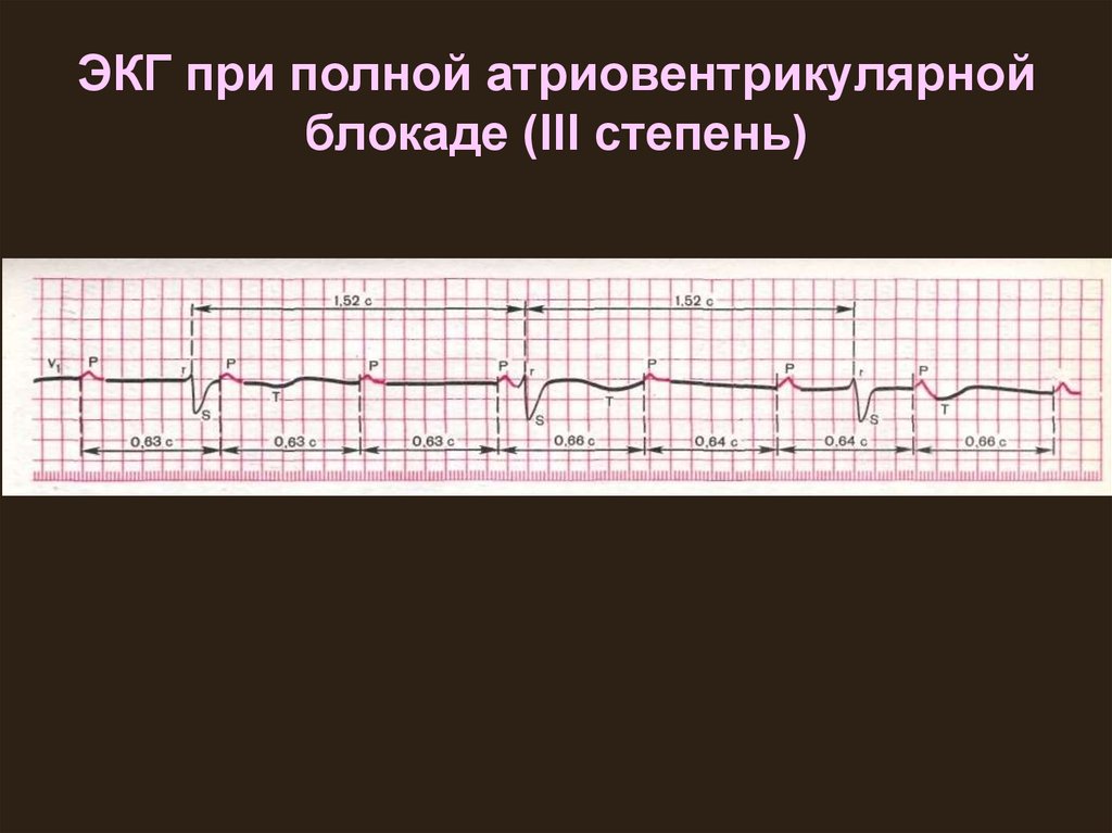 Полная блокада на экг. ЭКГ при атриовентрикулярной блокаде 3 степени. Полная атриовентрикулярная блокада 3 степени на ЭКГ. ЭКГ при АВ блокаде 3 степени. Полная АВ блокада 3 степени ЭКГ.