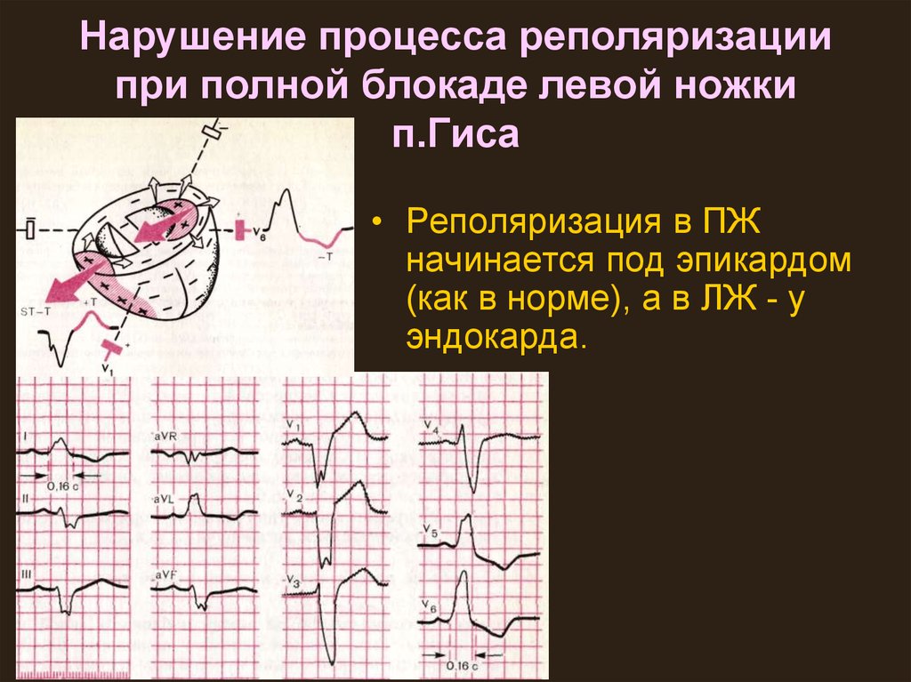 Диффузное нарушение процесса реполяризации сердца. Процесс реполяризации в миокарде на ЭКГ. Синдром изменений процессов реполяризации. Нарушение процесса реполяризации умеренные на ЭКГ что это такое. Нарушение реполяризации миокарда на ЭКГ.