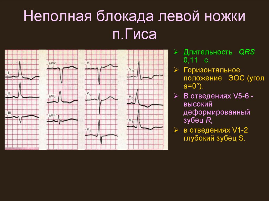 Неполная блокада правой ножки пучка гиса экг. Неполная блокада ЛНПГ на ЭКГ. Неполная блокада левой ножки пучка Гиса на ЭКГ. ЭКГ частичная блокада левой ножки пучка. ЭКГ при неполной блокаде левой ножки пучка Гиса.