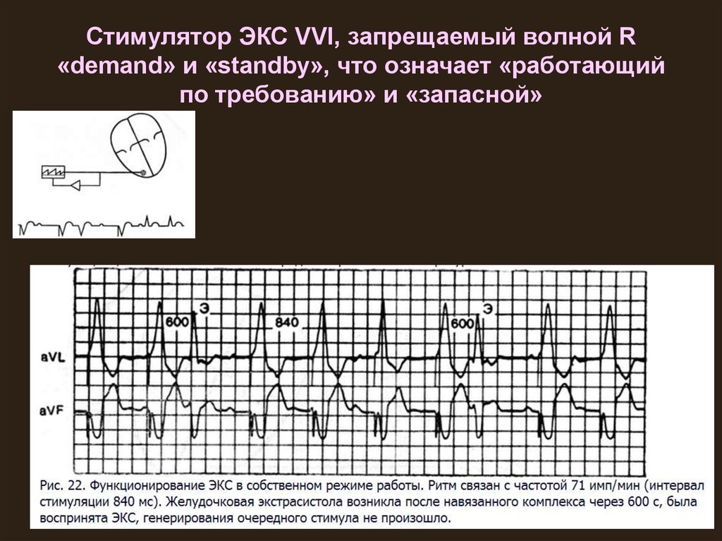 Назначение экс. ЭКГ при стимуляции в режиме VVI. Экс в режиме VVI. Режим VVI кардиостимулятора. Режим стимуляции VVI.