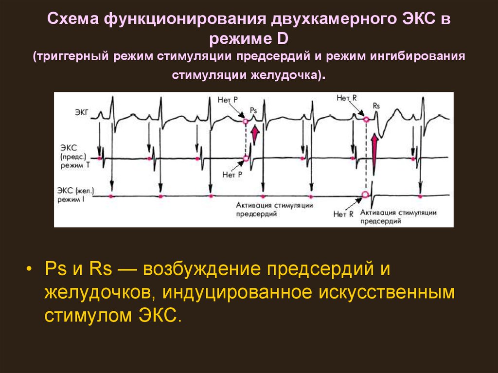 Дисфункция предсердий. Двухкамерный кардиостимулятор на ЭКГ. Ритм стимулятора на ЭКГ. Режимы работы кардиостимулятора. Ритм искусственного водителя ритма на ЭКГ.