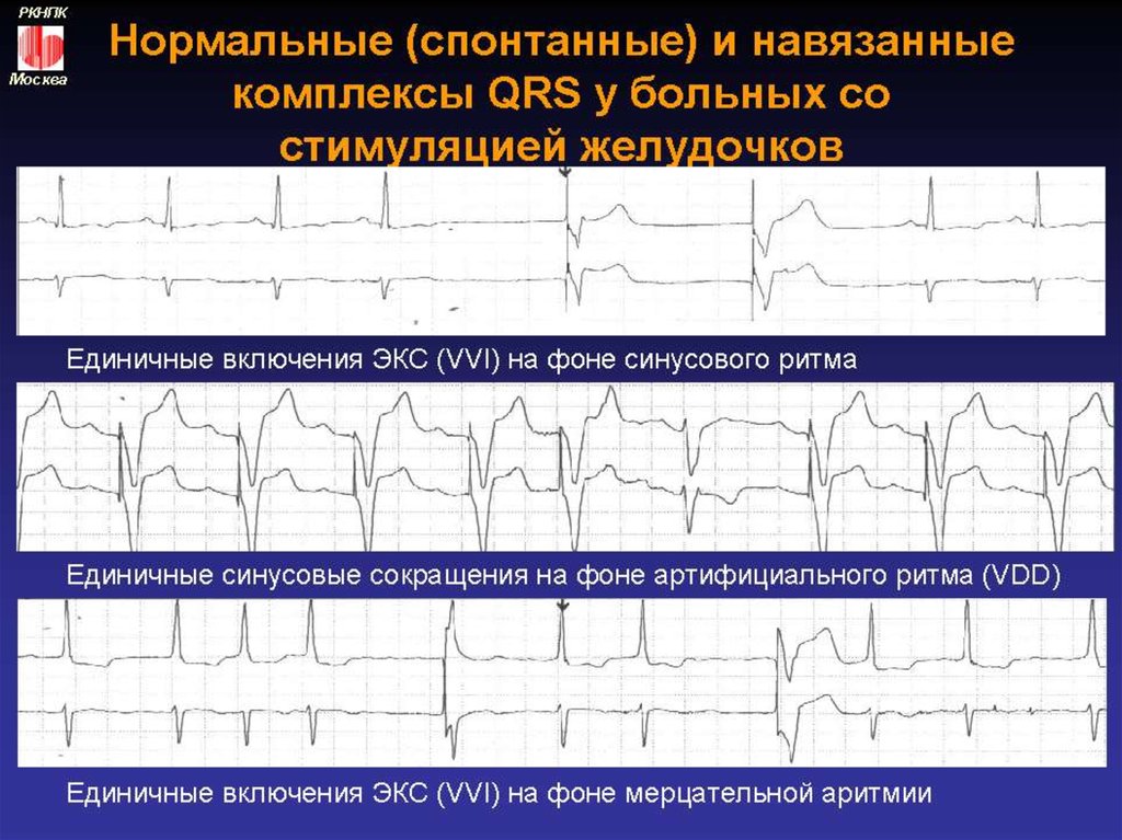 Сливной экс. Сливные желудочковые комплексы на ЭКГ С экс. Заключение холтеровского мониторирования ЭКГ при кардиостимуляторе. Холтеровское мониторирование фибрилляция предсердий. Экс желудочковой стимуляции на ЭКГ.