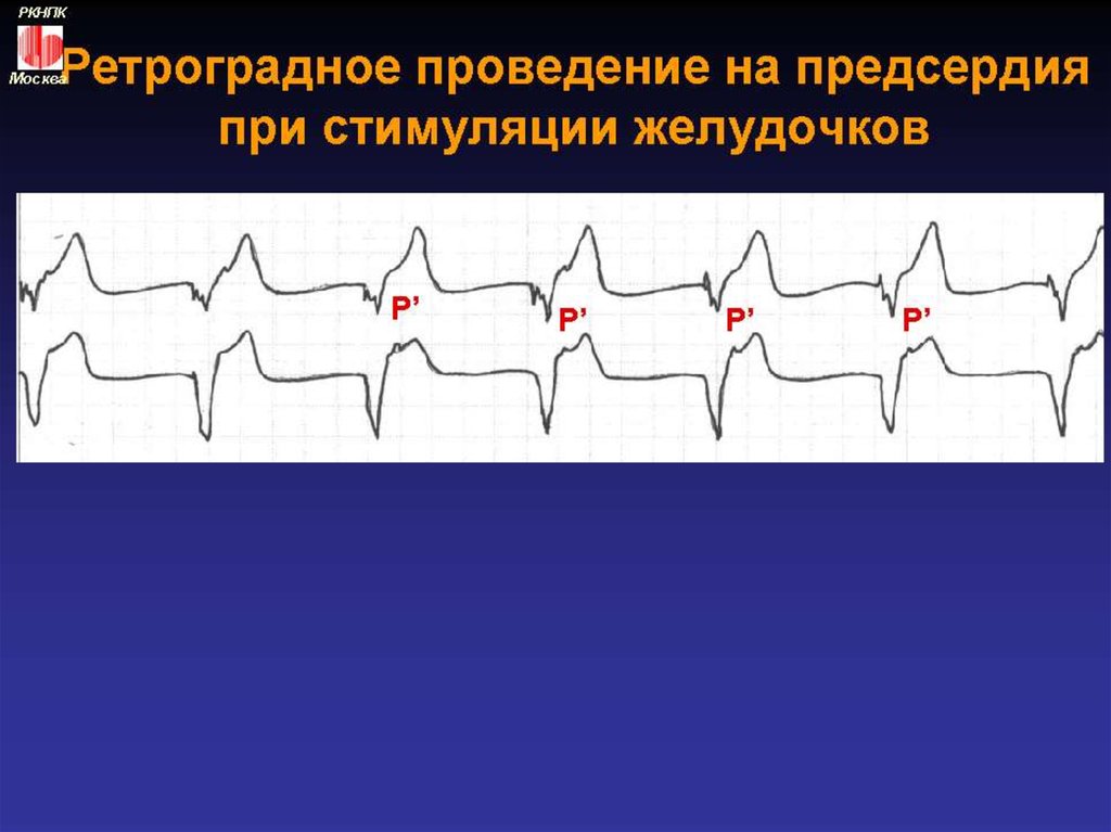 Путем экс. Ретроградное проведение на предсердия. Ретроградное проведение на ЭКГ. Ретроградное вентрикулоатриальное проведение. Ретроградное возбуждение предсердий ЭКГ.