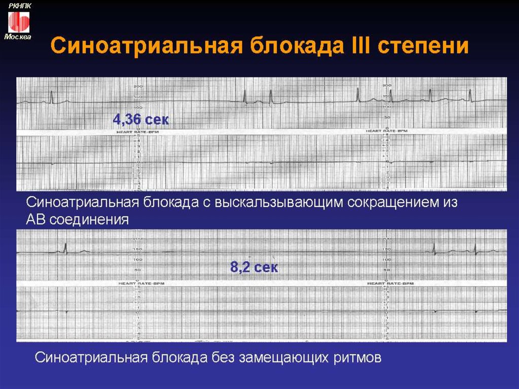 Признаки синоатриальной блокады. ЭКГ при синоатриальной блокаде 3 степени. Признаки синоатриальной блокады 3 степени. Синоатриальная блокада первой степени. Са блокада 3 степени на ЭКГ.