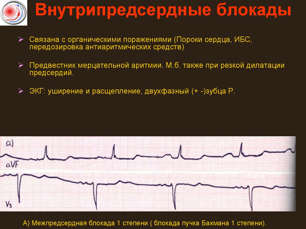 Блокада сердца это опасно. Блокада Бахмана 1 степени. Внутрипредсердная блокада 2 степени на ЭКГ. Межпредсердная блокада 1 степени что это такое на ЭКГ. Внутрипредсердные блокады на ЭКГ.