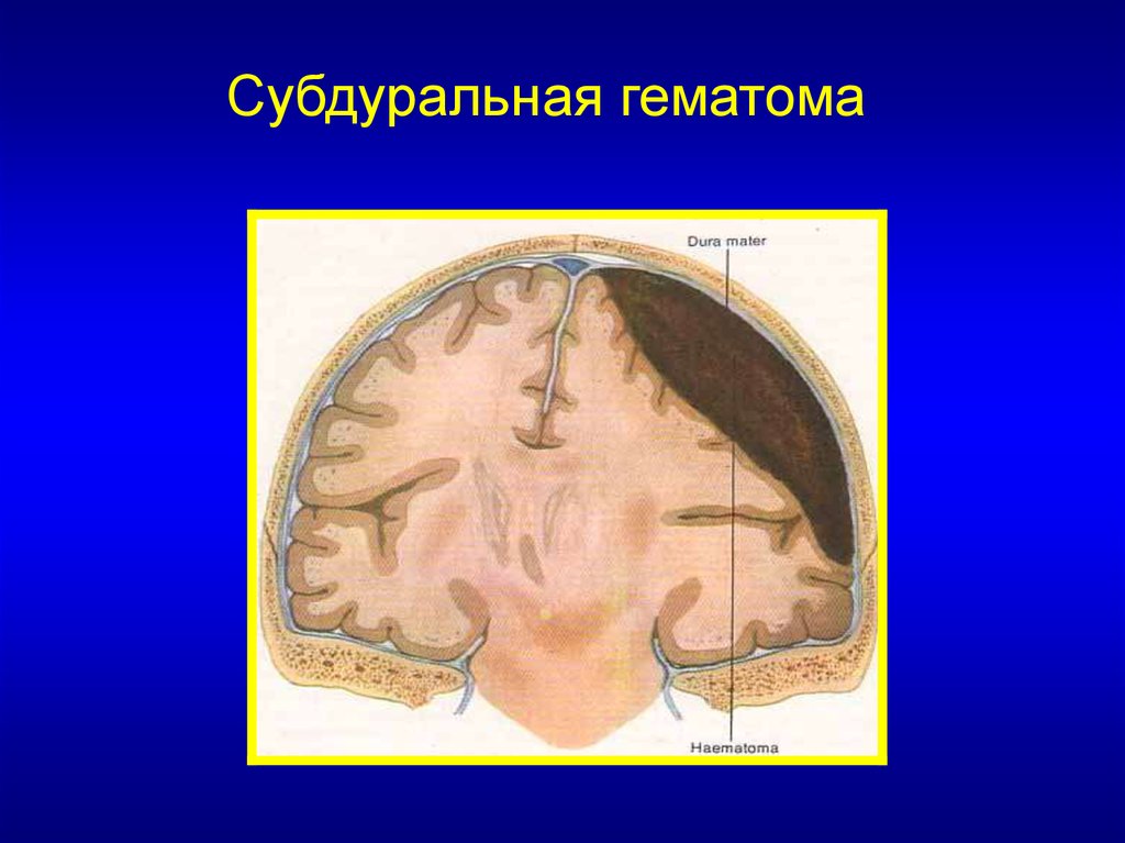 Субдуральное кровоизлияние это. Субдуральная и эпидуральная гематома. Гематома субдуральная травматическая. Субдуральное кровоизлияние головного мозга. Субдуральное кровоизлияние кт.