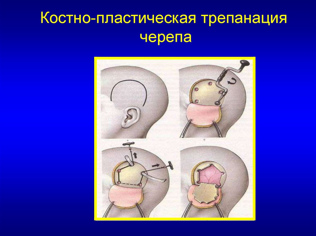 Способы трепанации. Резекционная Трепанация черепа этапы операции. Техника костнопластической трепанации черепа. Костно-пластическая Трепанация черепа по Оливекрону. Декомпрессионная Трепанация черепа по Кушингу.