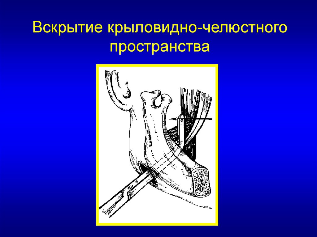 Крыловидно нижнечелюстное пространство. Крыловидно челюстное пространство. Абсцесс крыловидно челюстного пространства вскрытие. Вскрытие абсцесса крыловидно-нижнечелюстного пространства.