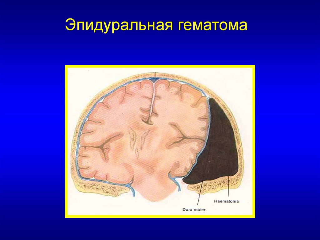 Субдуральное кровоизлияние это. Субдуральная и эпидуральная гематома. Эпидуральная гематома топографическая анатомия. Эпидуральная гематома на кт.