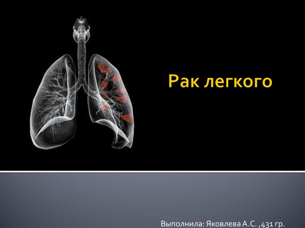 Рак легкого презентация онкология