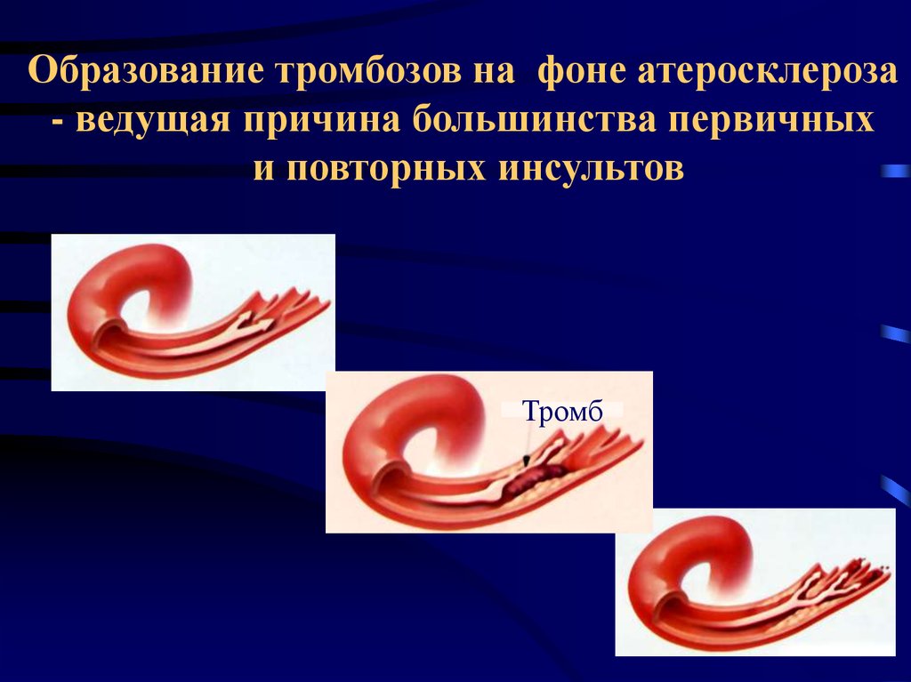 Причины тромбоза. Причины образования тромбоза. Тромб причины образования. Предпосылки образования тромба. Причины формирования тромба.