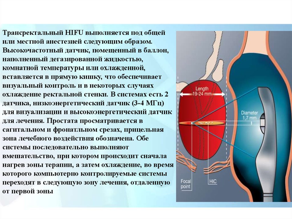 Лечение зона. HIFU простаты. HIFU-терапия РПЖ. HIFU предстательной железы это. Зоны терапевтической.