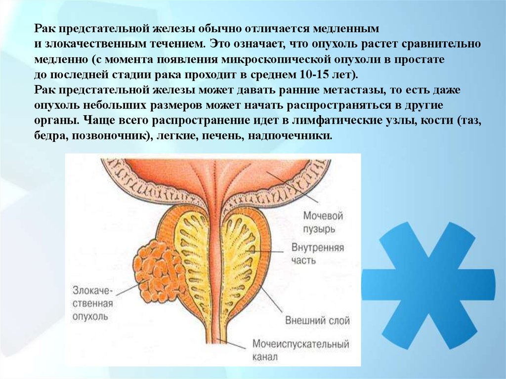 Предстательная железа это простата. Онкология предстательной железы. Карцинома предстательной железы. Злокачественное новообразование предстательной железы. Объемное образование предстательной железы.