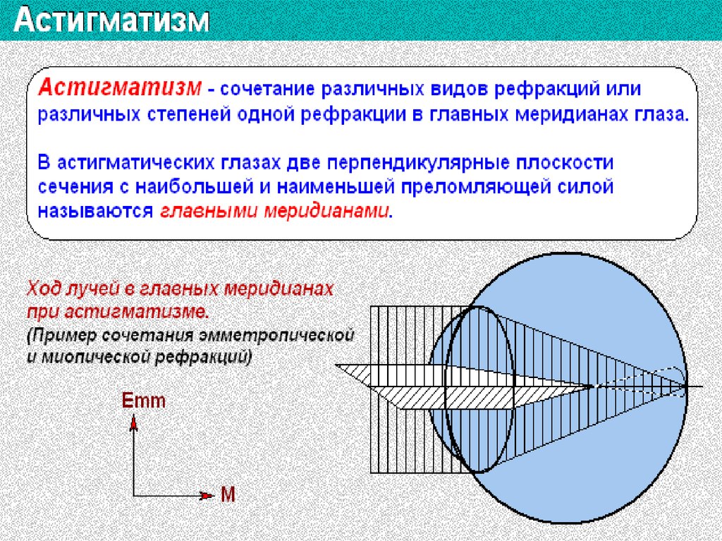 Астигматизм что это такое. Ход лучей в астигматическом глазу. Физическая и клиническая рефракция. Астигматизм ход лучей. Рефракция и аккомодация глаза.