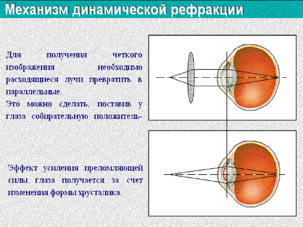 Изображения в близоруком глазу фокусируется