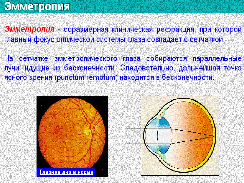 Рефракция глаза презентация