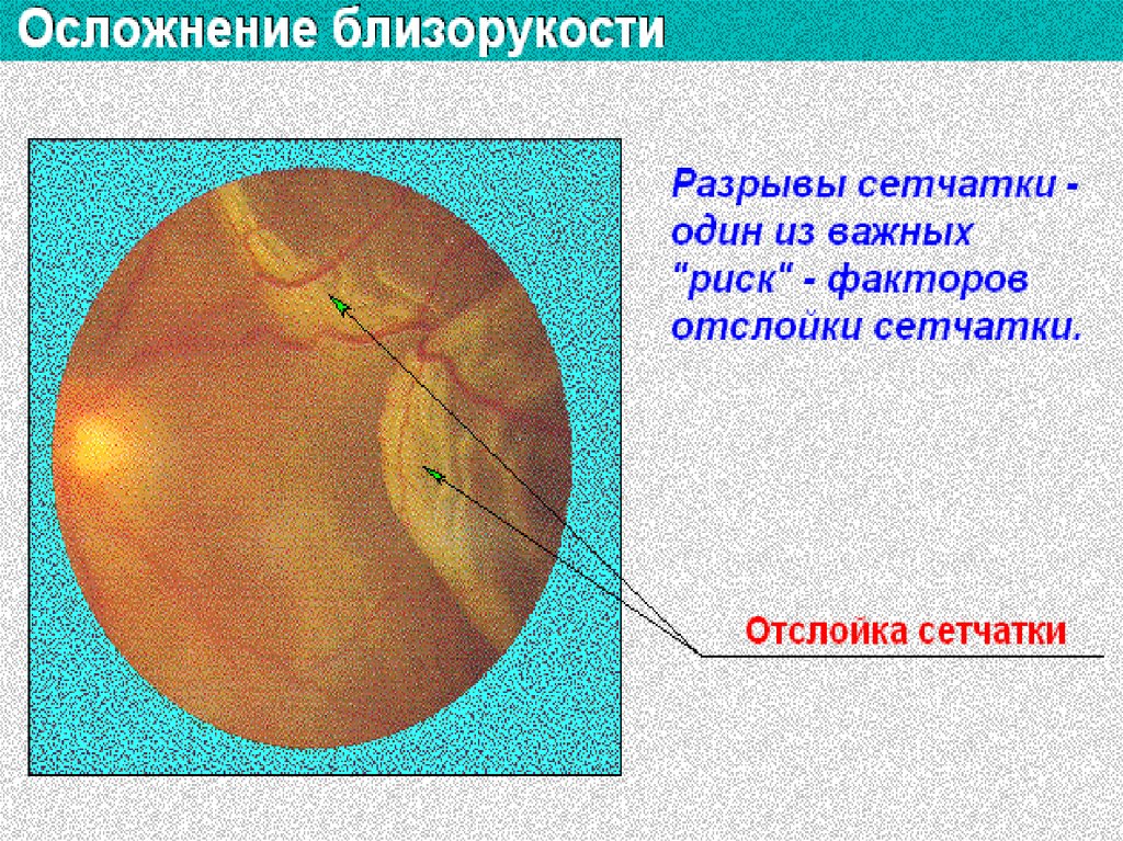 Аккомодация сетчатки. Рефракция и аккомодация глаза. Аккомодация это в офтальмологии. Рефракция это в офтальмологии. Аккомодация презентация.