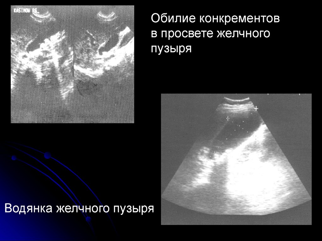 Калькулезный пиелонефрит