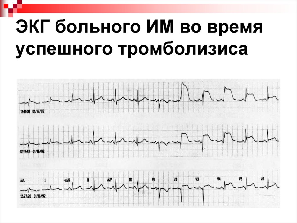 Экг после. ЭКГ после тромболизиса. Кардиограмма больного. Кардиограмма больного сердца. ЭКГ больного сердца.