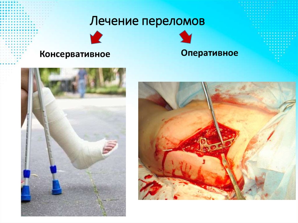 Лечение переломов