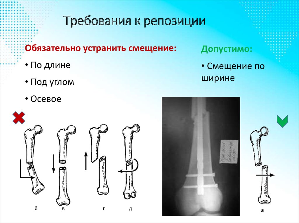 Открытая репозиция костей