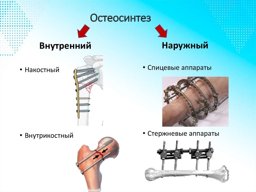 Переломы костей операция. Стержневые аппараты внеочагового остеосинтеза. Наружный чрескостный остеосинтез. Чрескожный остеосинтез стержневой. Интрамедуллярный и экстрамедуллярный остеосинтез.