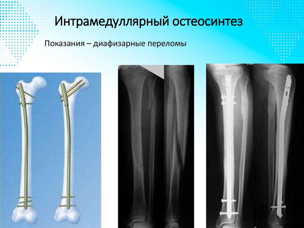 Интрамедуллярный остеосинтез
