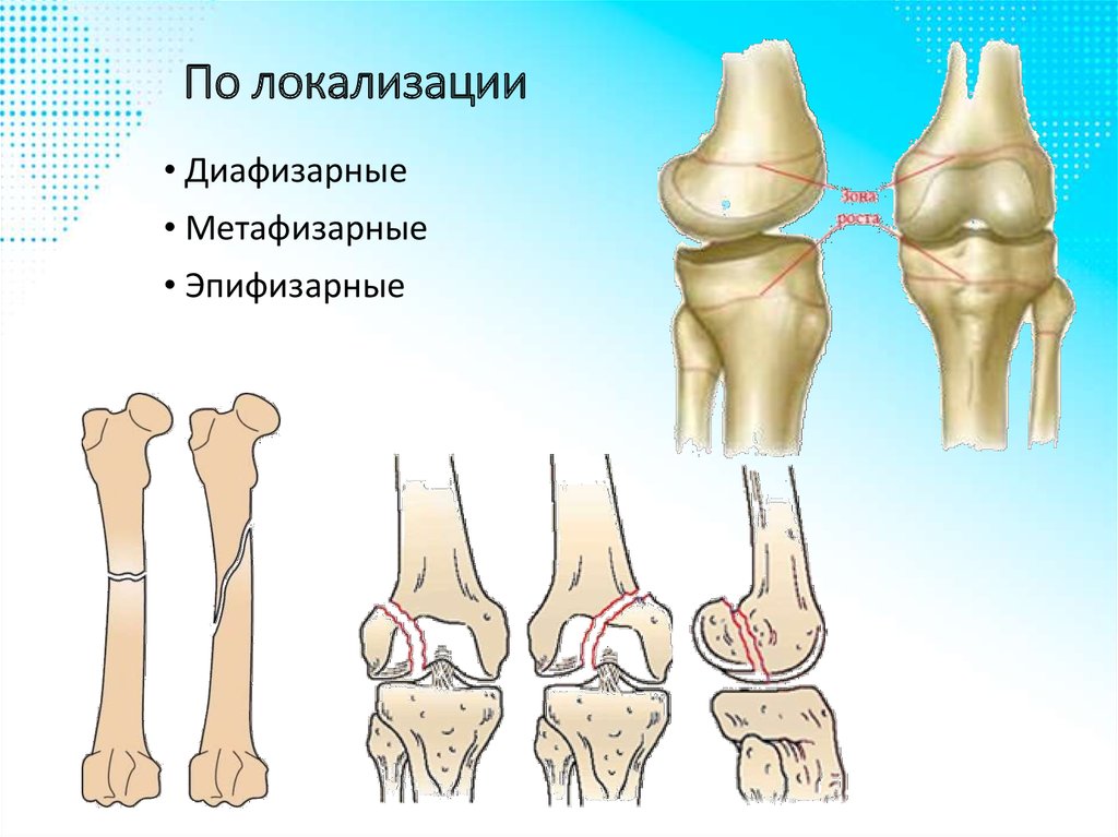 Дистальные переломы бедренной кости. Внутрисуставной перелом бедренной кости. Диафизарные переломы большеберцовой кости. Эпифизарные переломы большеберцовой кости. Внутрисуставные переломы классификация.